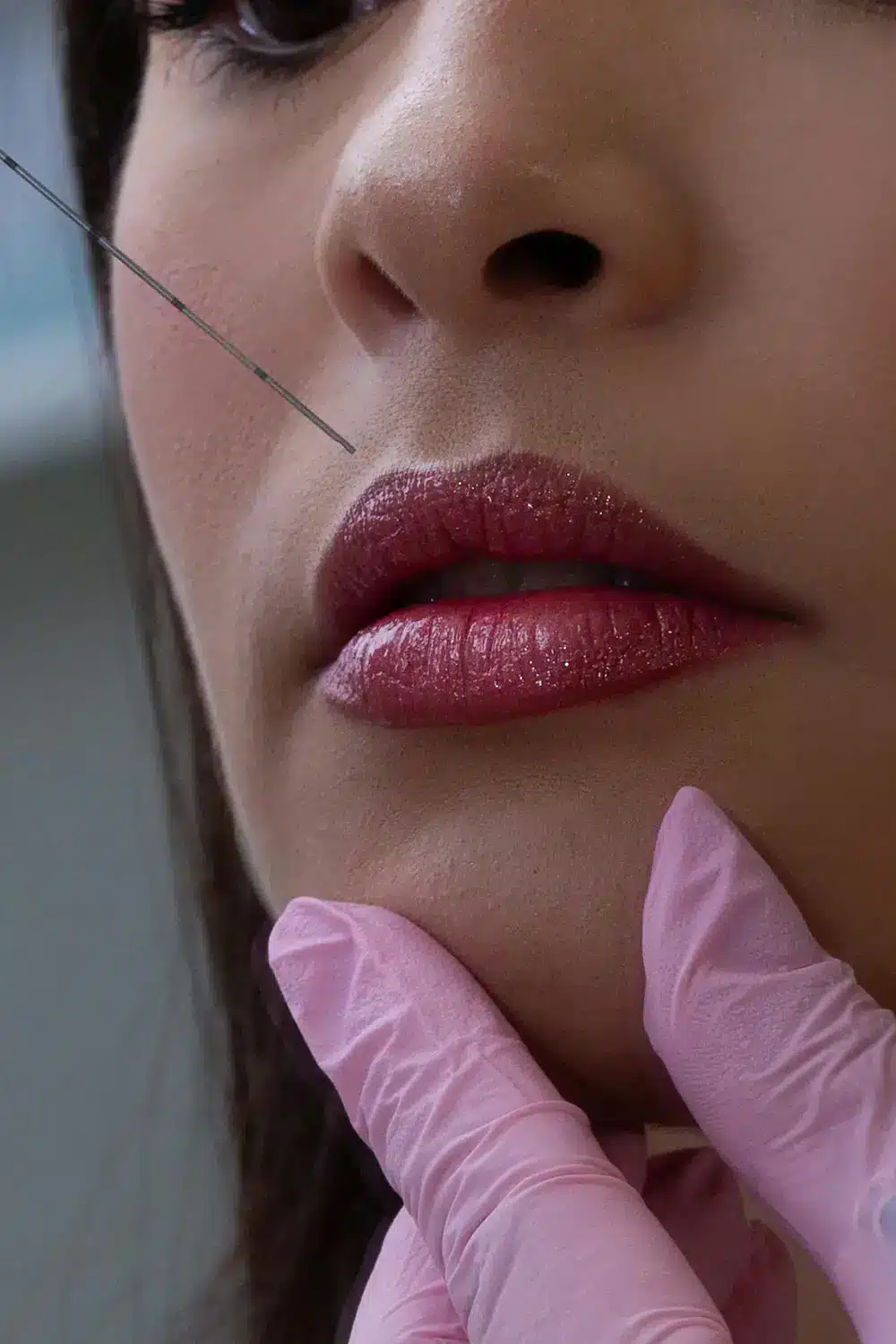 iniezione labbra di botox