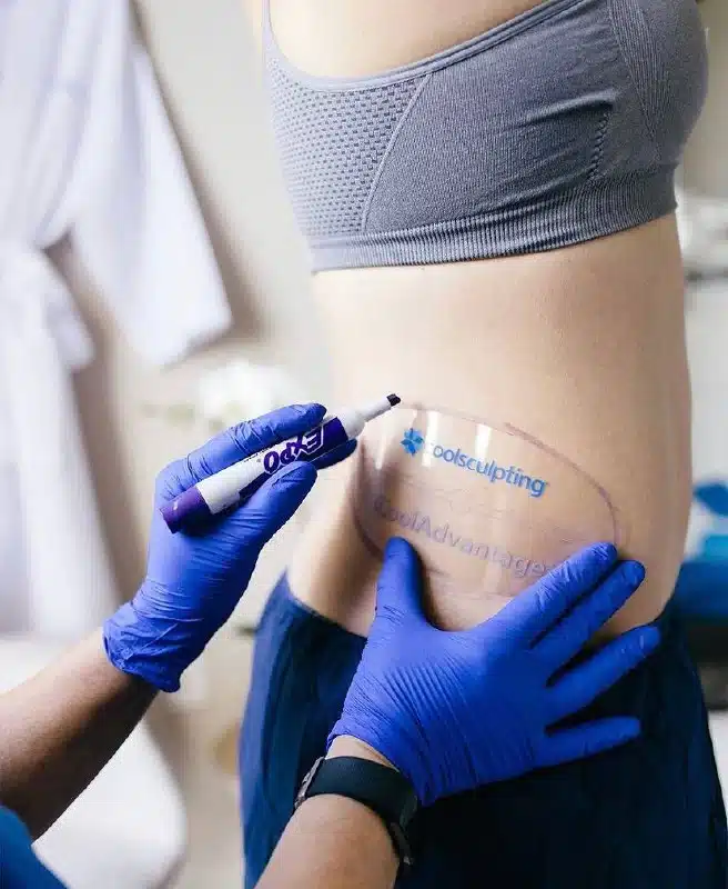 trattamento non invasivo per grasso localizzato