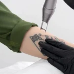 rimozione tatuaggio con laser