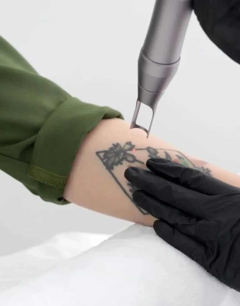 rimozione tatuaggio con laser