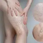 capillari evidenti sulle gambe