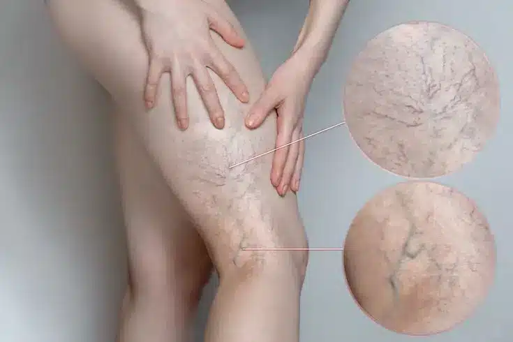 capillari evidenti sulle gambe