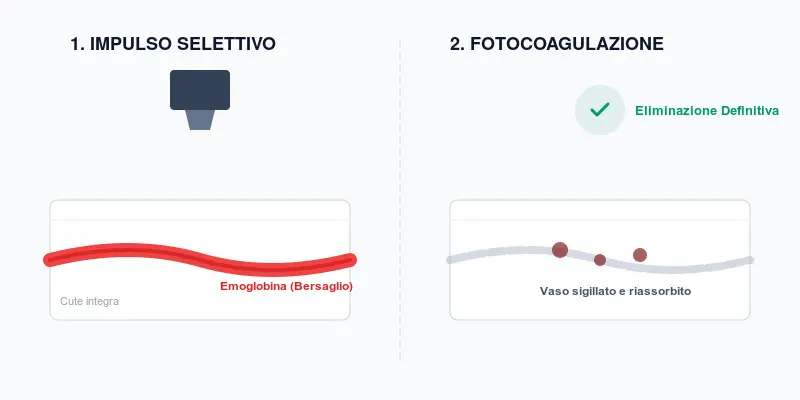 spiegazione fotocoagulazione