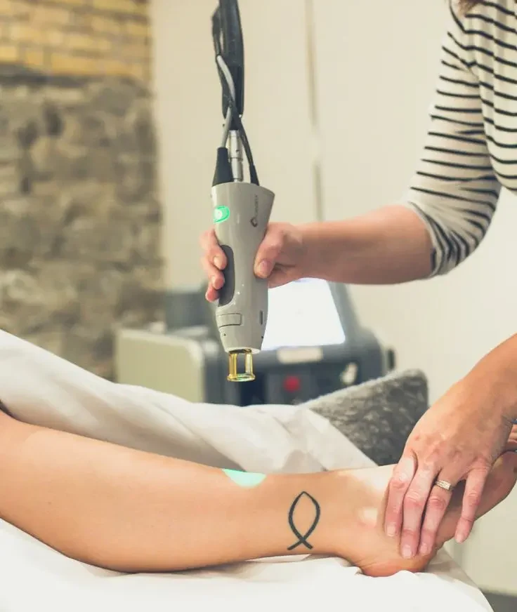 trattamento epilazione laser