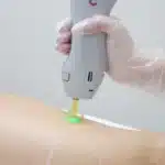 trattamento corpo con laser