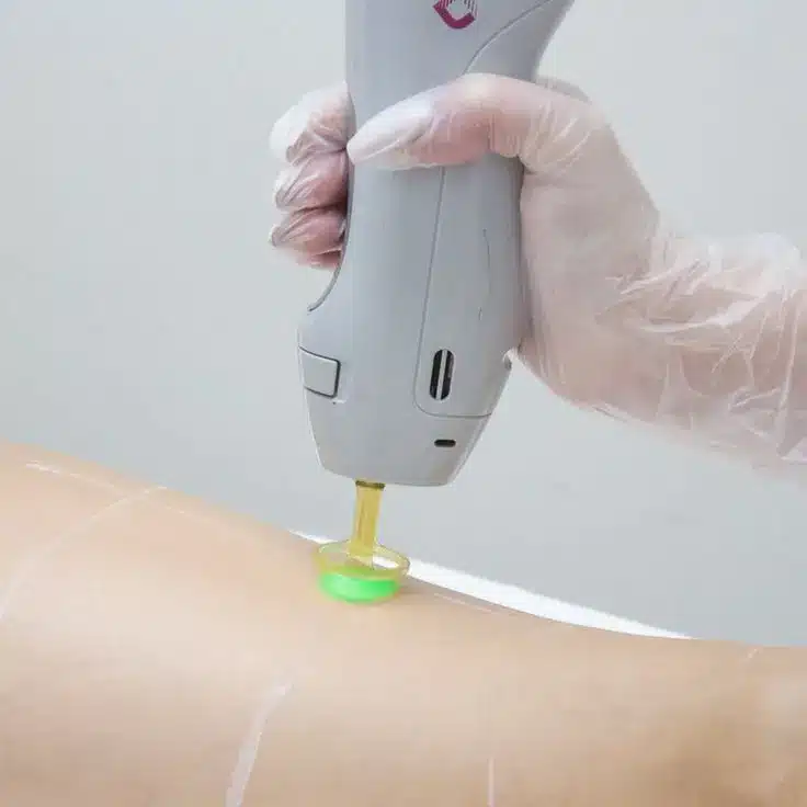 trattamento corpo con laser