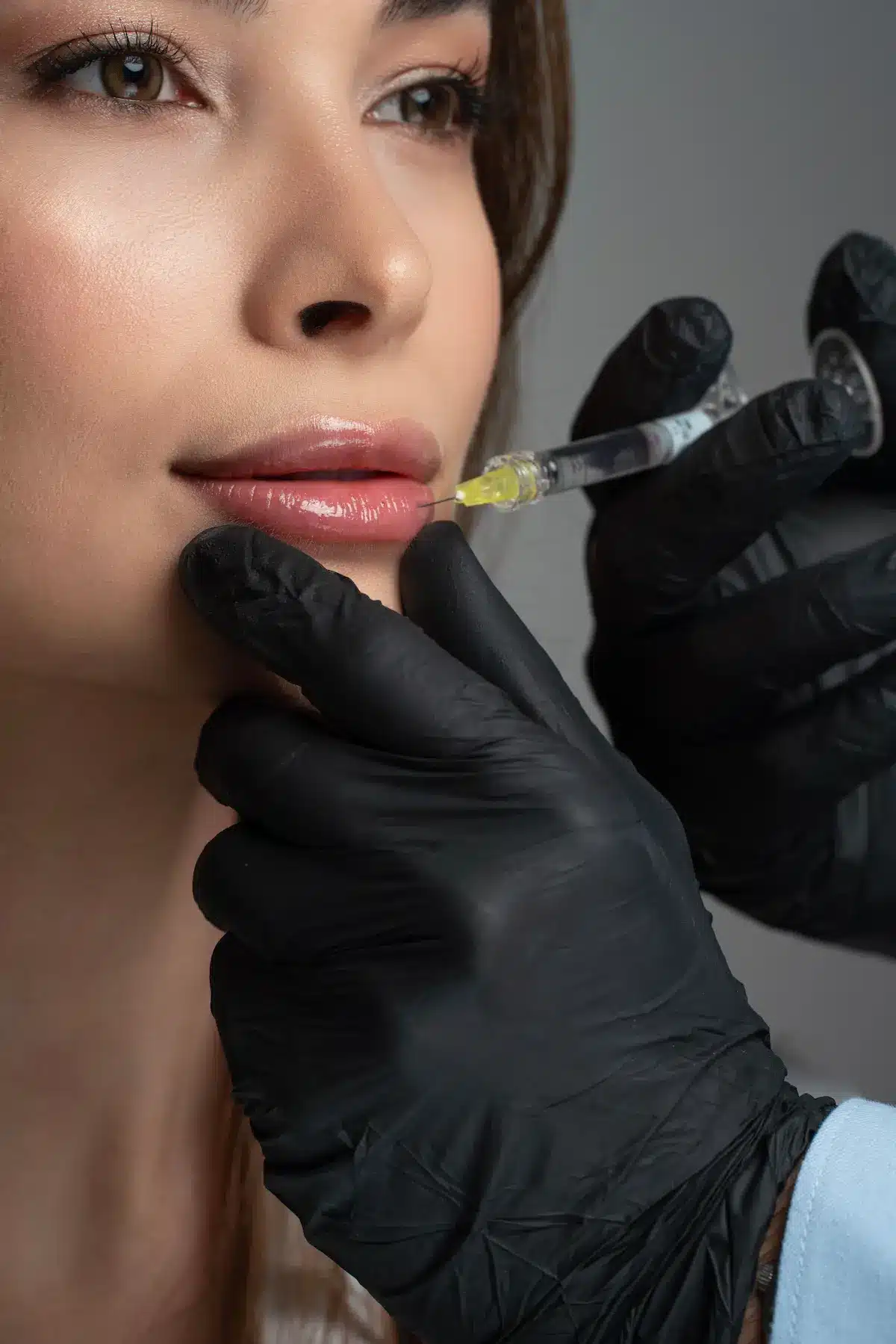 filler labbra