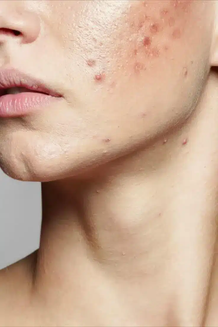 viso di donna con acne
