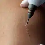 laser che rimuove cicatrici