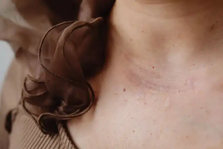 collo di una donna con una cicatrice