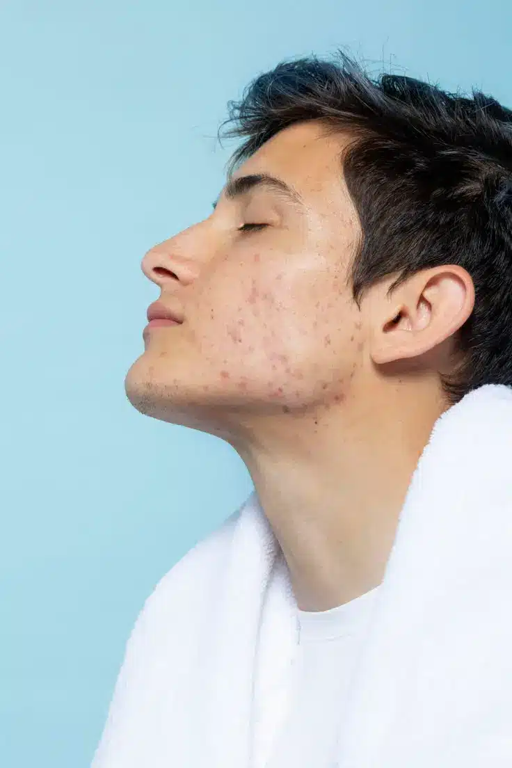 uomo con cicatrici da acne