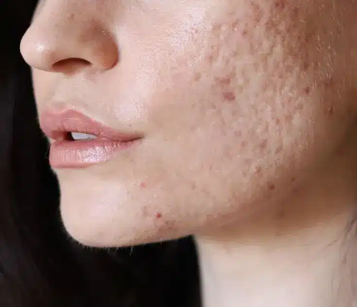 guance con cicatrici da acne