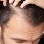 attaccatura capelli uomo