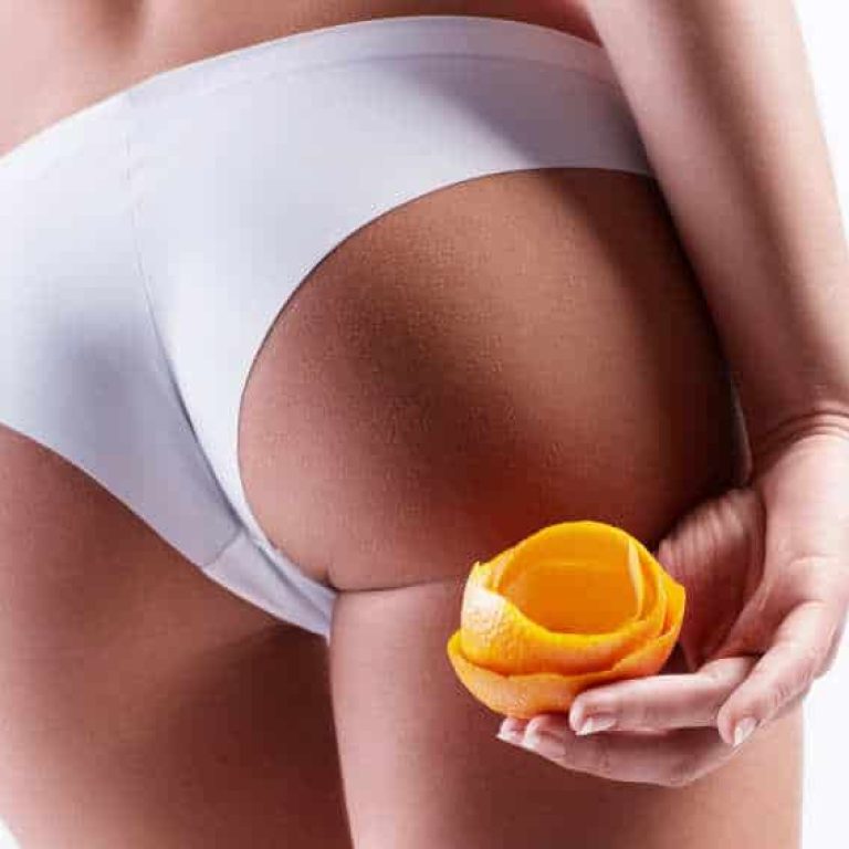 cell cut subcision cellulite aurial