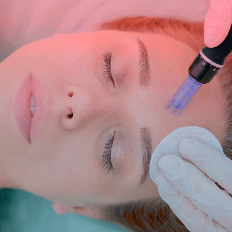 microneedling in aurial