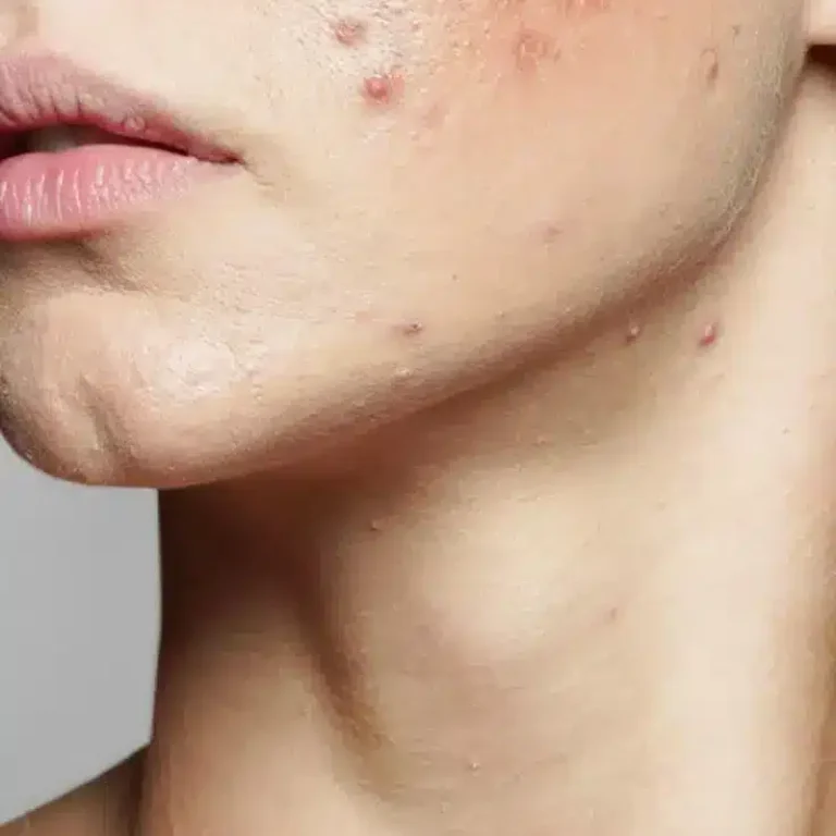 viso di donna con acne