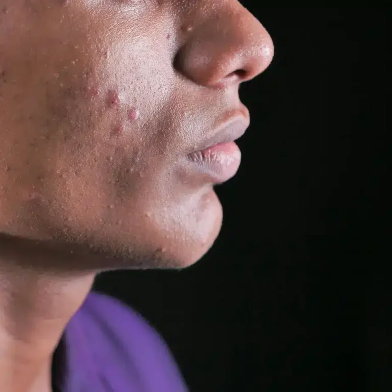 uomo con evidente acne