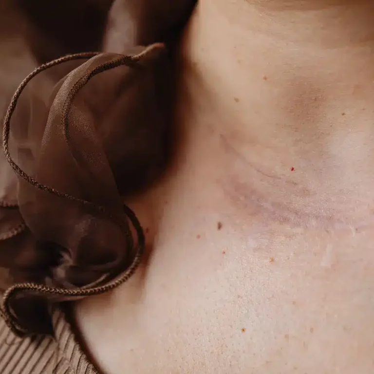 collo di una donna con una cicatrice