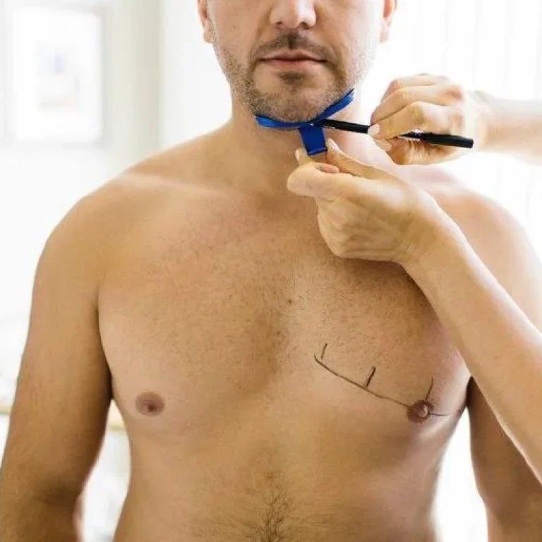 aureal-coolsculpting-doppio-mento