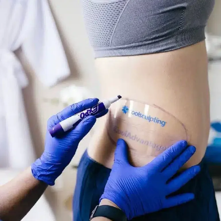 coolsculpting aurial