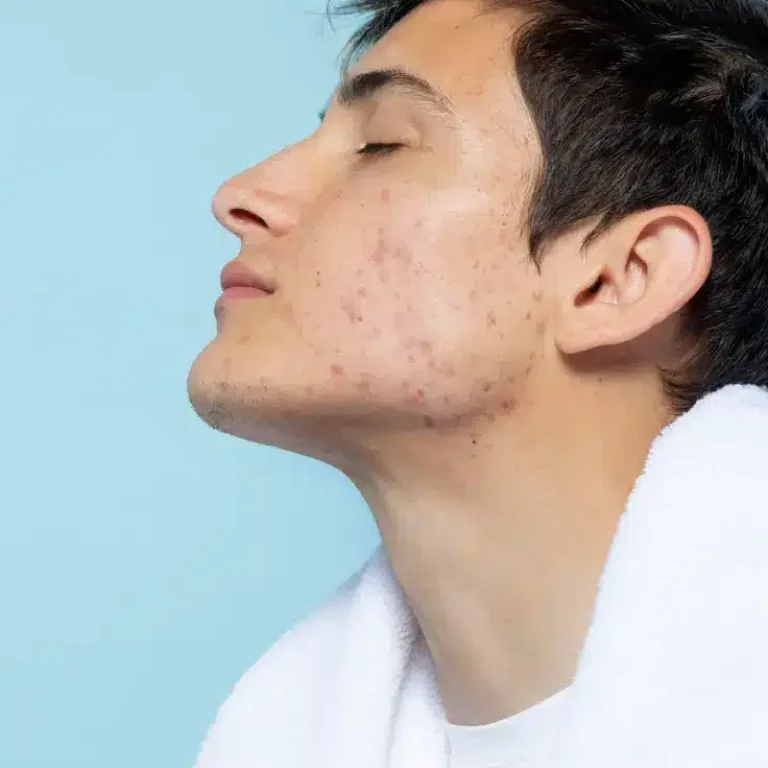 uomo con cicatrici da acne