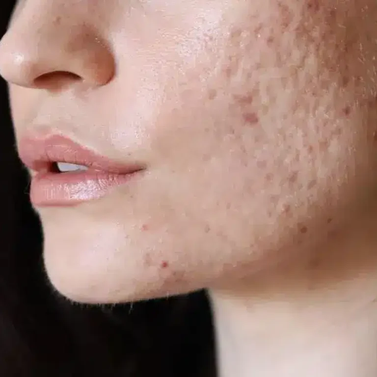 guance con cicatrici da acne