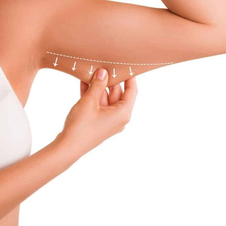 coolsculpting braccia criolipolisi aurial