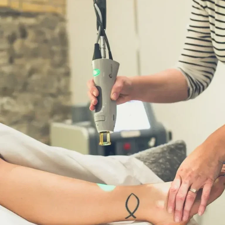 trattamento epilazione laser