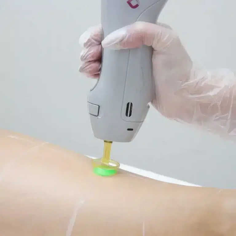 trattamento corpo con laser
