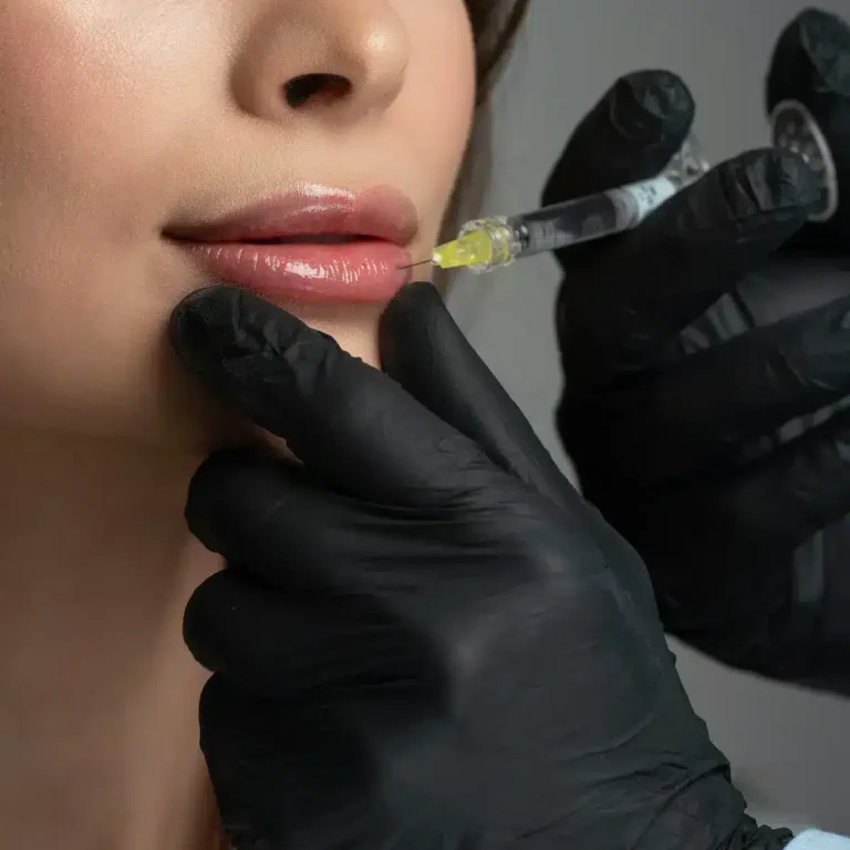 Iniezione di acido ialuronico nelle labbra di una donna
